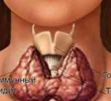 Simptomele si tratamentul tiroiditei autoimune