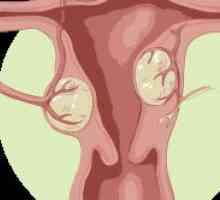 Simptomele si tratamentul fibrom uterin subseros interstițiale