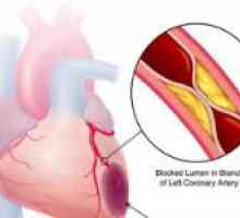 Simptomele și tratamentul ischemiei miocardice