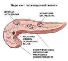 Simptomele și tratamentul de polipi in pancreas