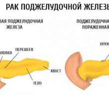 Simptomele si etapele de cancer pancreatic a capului