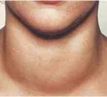 Simptomele și tratamentul gușă difuză a glandei tiroide