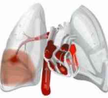 Embolie pulmonară (PE)
