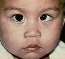 Sindromul de ochi lenes (ambliopia) la adulți și copii