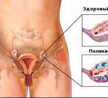Sindromul ovarului polichistic si sarcina