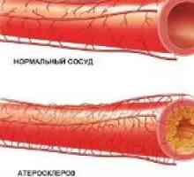 Scleroza vasculara a membrelor inferioare și tratamentul acesteia