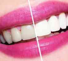 Cât de mult pentru albirea dinților în stomatologie?