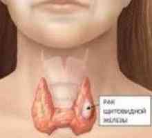 Cât de mulți trăiesc în tratamentul cancerului tiroidian