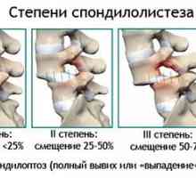 Deplasarea coloanei vertebrale lombare