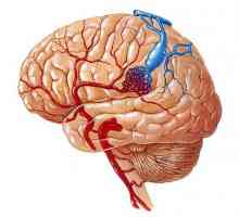 Malformatii vasculare ale creierului: tipuri, simptome, diagnostic, tratament