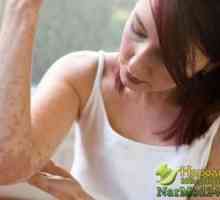 Sfaturi pentru tratamentul dermatitei atopice la domiciliu