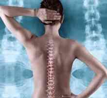 Accident vascular cerebral spinal: cauze, simptome, tratament, reabilitare, prognostic