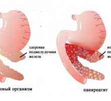 Vindecarea dieta in pancreatita acuta