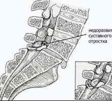 Coloanei vertebrale spondiloliză