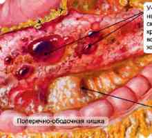 Tipuri și tratamentul hemoragic necrozantă pancreatită