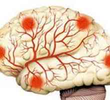 Ce instrumente sunt cele mai potrivite pentru consolidarea vaselor de sânge ale creierului?