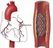 Stentarea vasculare: indicatii, chirurgie, reabilitare