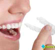 Costul capace pentru a alinia dintii: descriere, tipuri și categorii de preț