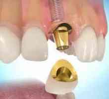 Costul de implanturi dentare, precum și opiniile lor