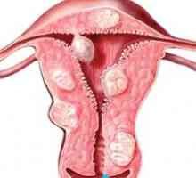Ar trebui să am un avort pentru fibrom uterin?
