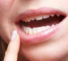 Cum de a trata stomatită în gură la adulți? tehnici și metode dovedite