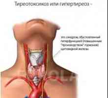 Tireotoxicoză (hipertiroidie), simptome la femei, forme ale bolii, diagnostic și tratament