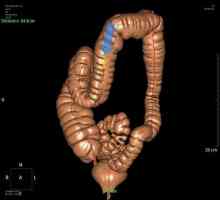 Sunt rezultatele exacte ofera intestinului colonoscopie virtuala?