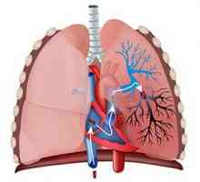 Embolie pulmonară (PE): cauze, simptome, tratament