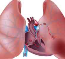 Embolia si tromboza arterei pulmonare