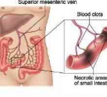 Tromboza vaselor mezenterice ale intestinului