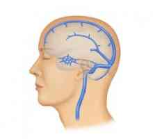 Tromboza sinusurilor cerebrale: cauze, simptome, tratament