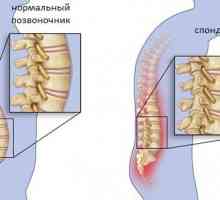 Tuberculoza a coloanei vertebrale