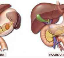 Eliminarea pancreasului