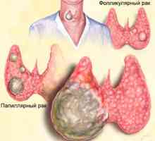Îndepărtarea glandei tiroide și prognostic determinarea cancerului dupa operatie