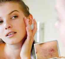 Îngrijire facială - Cum de a elimina petele de pe fața tuturor acnee
