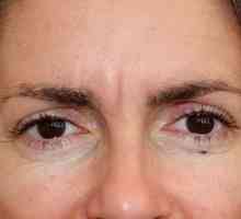Injecțiile cu Botox anti-rid între sprâncene