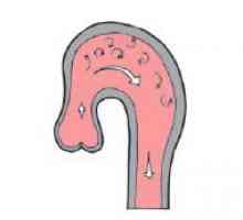 Sigiliul a aortei (pliante supapa, rădăcina arcului): simptome, cauze, cum de a vindeca