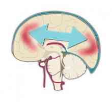 Leziuni cerebrale: cauze, simptome si diagnostic, tratament, prognostic, reabilitare