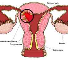 Sfaturi ginecologul: atunci când face cu ultrasunete pentru endometrioza