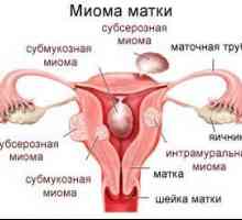 Fibrom uterin nodular