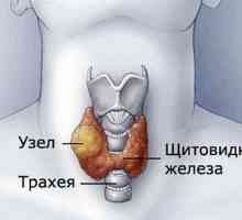 Simptomele de noduri la nivelul glandei tiroide