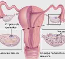 O problemă importantă pentru multe femei: cum de a vindeca sindromul ovarului polichistic?