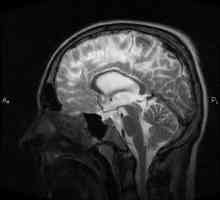 Hidrocefalie internă a creierului