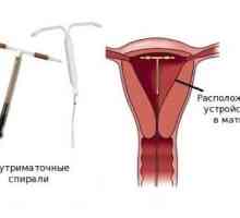Intrauterina dispozitive de contracepție: Care este mai bine?