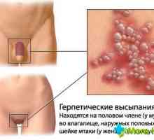 Blistere pe labiilor (herpes genital)