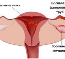 Inflamarea ovarelor sau anexita