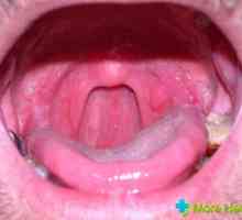 Inflamarea limbii în gât: tratamentul este metodele conservatoare și tradiționale