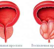 Inflamația prostatei (prostatita)
