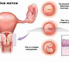 Inflamarea colului uterin sau tservitit