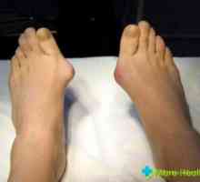 Apariția creșterilor de pe degetele de la picioare și tratarea acestora
